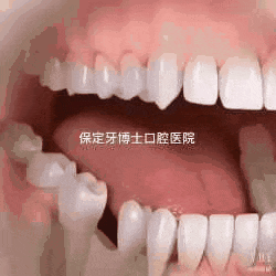 保定种牙多少钱一颗牙齿