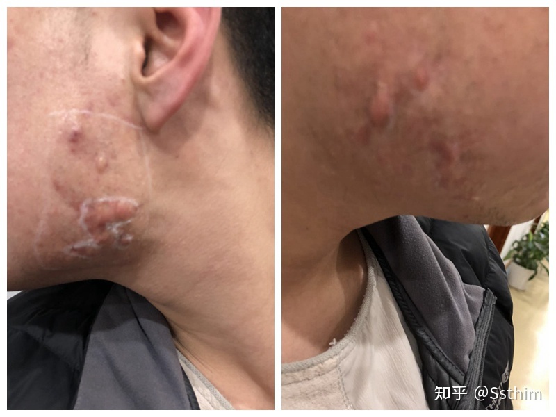 中药去疤痕