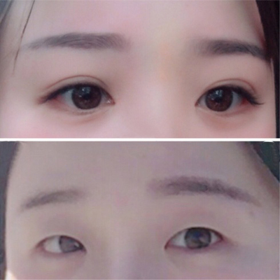 双眼皮开眼角要多少钱