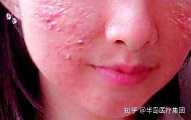 什么样的痘痘是痤疮