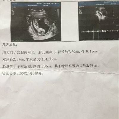胎儿双顶径标准看男女