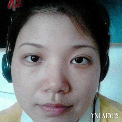 双眼皮会失败吗