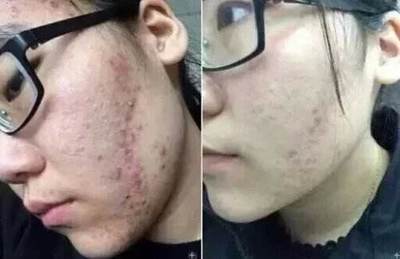 脸上好多痘印痘痘可以用维e吗
