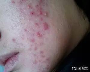 艾灸后脸上长痘是怎么回事