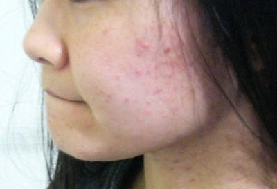 痘痘变大了是排毒