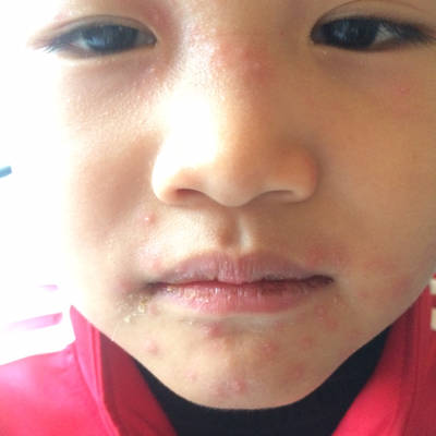 小孩脸上长小红点是怎么回事