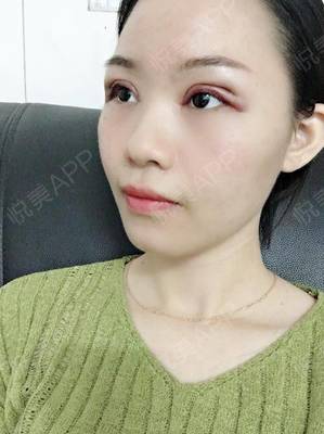 全切双眼皮多久能上班