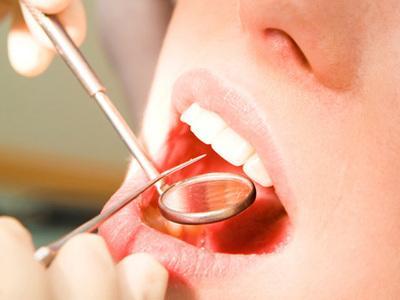 植雅牙膏治疗口腔溃疡  口腔溃疡怎么治疗。 