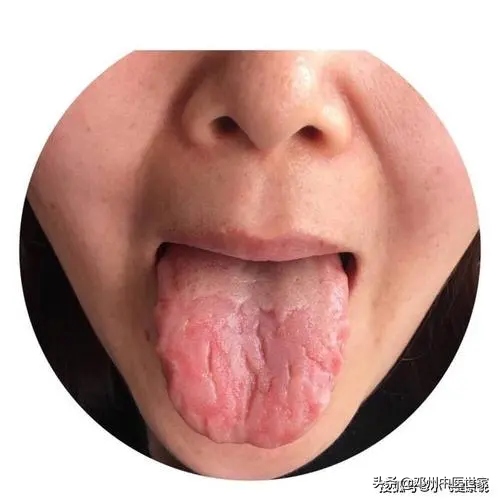 舌尖裂纹是怎么回事