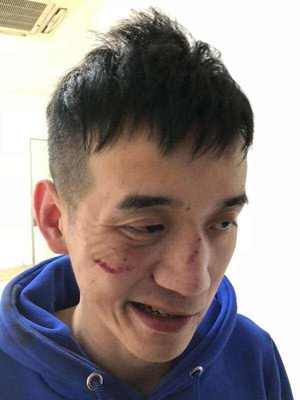 鼻骨线性骨折算轻伤吗