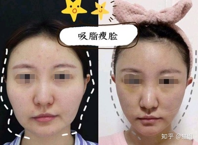 面部吸脂瘦脸效果好吗