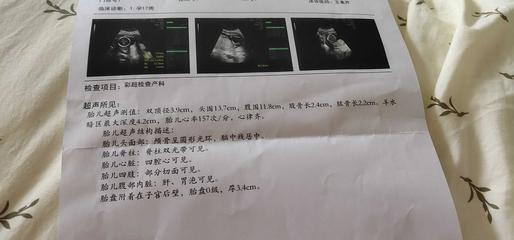 胎盘在右侧壁胎儿图片