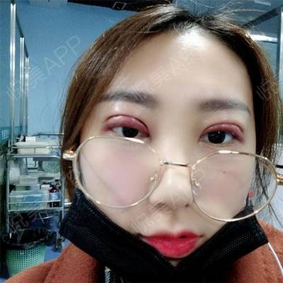全切双眼皮多久能上班
