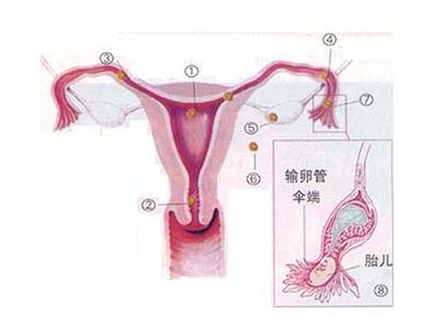 多少时间会宫外孕早期症状