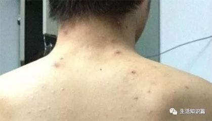 背部堵塞起痘痘怎么办