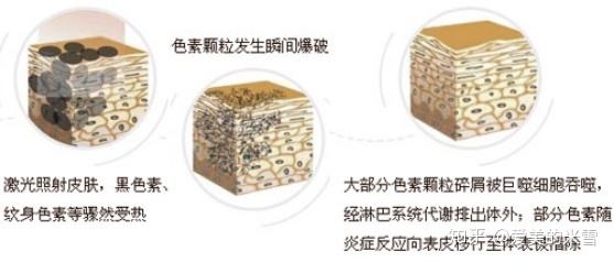 爆破祛斑对皮肤的伤害