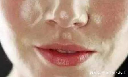 脸有油长痘痘怎么办啊