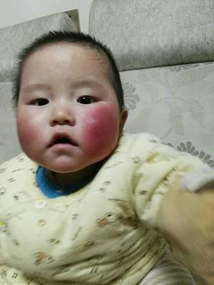 宝宝脸发红发烫怎么回事
