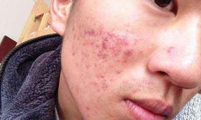 经常便秘涨痘痘去看内分泌