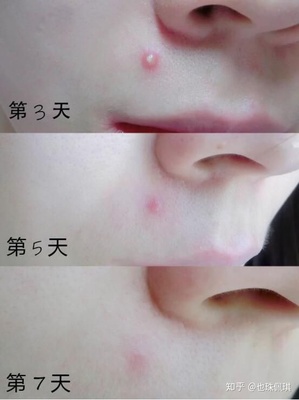 鼻子内壁长了一个痘痘