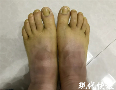 脚面浮肿是怎么回事