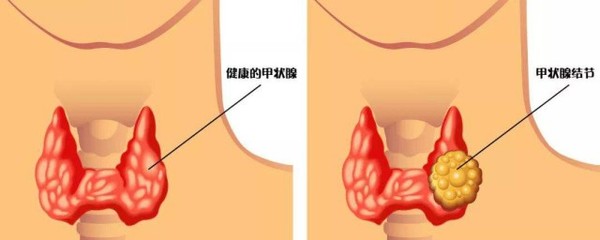 嗓子右边疼是怎么回事
