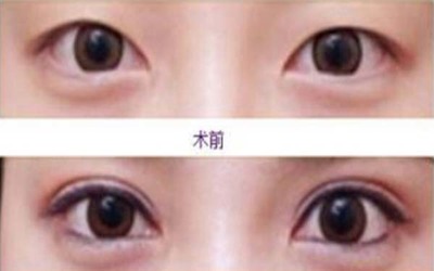 做双眼皮微创