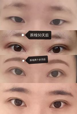 芜湖割双眼皮壹加壹优