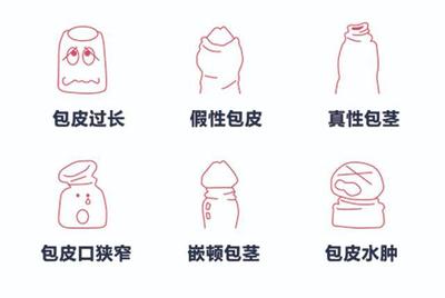 包皮浮肿是怎么回事