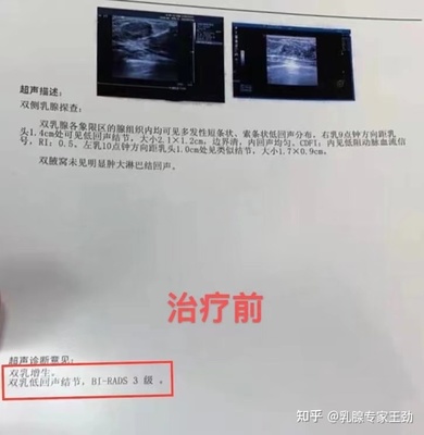 乳腺低回声结节是怎么回事