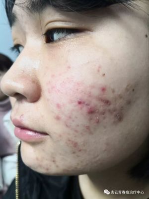 女孩子脸上有痘痘