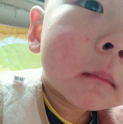 小孩脸上长小红点是怎么回事