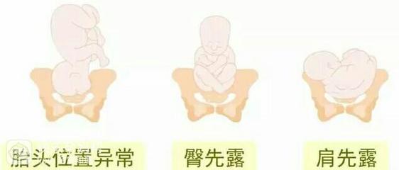 胎儿发育畸形
