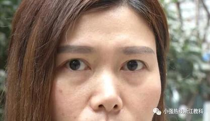 35岁割双眼皮