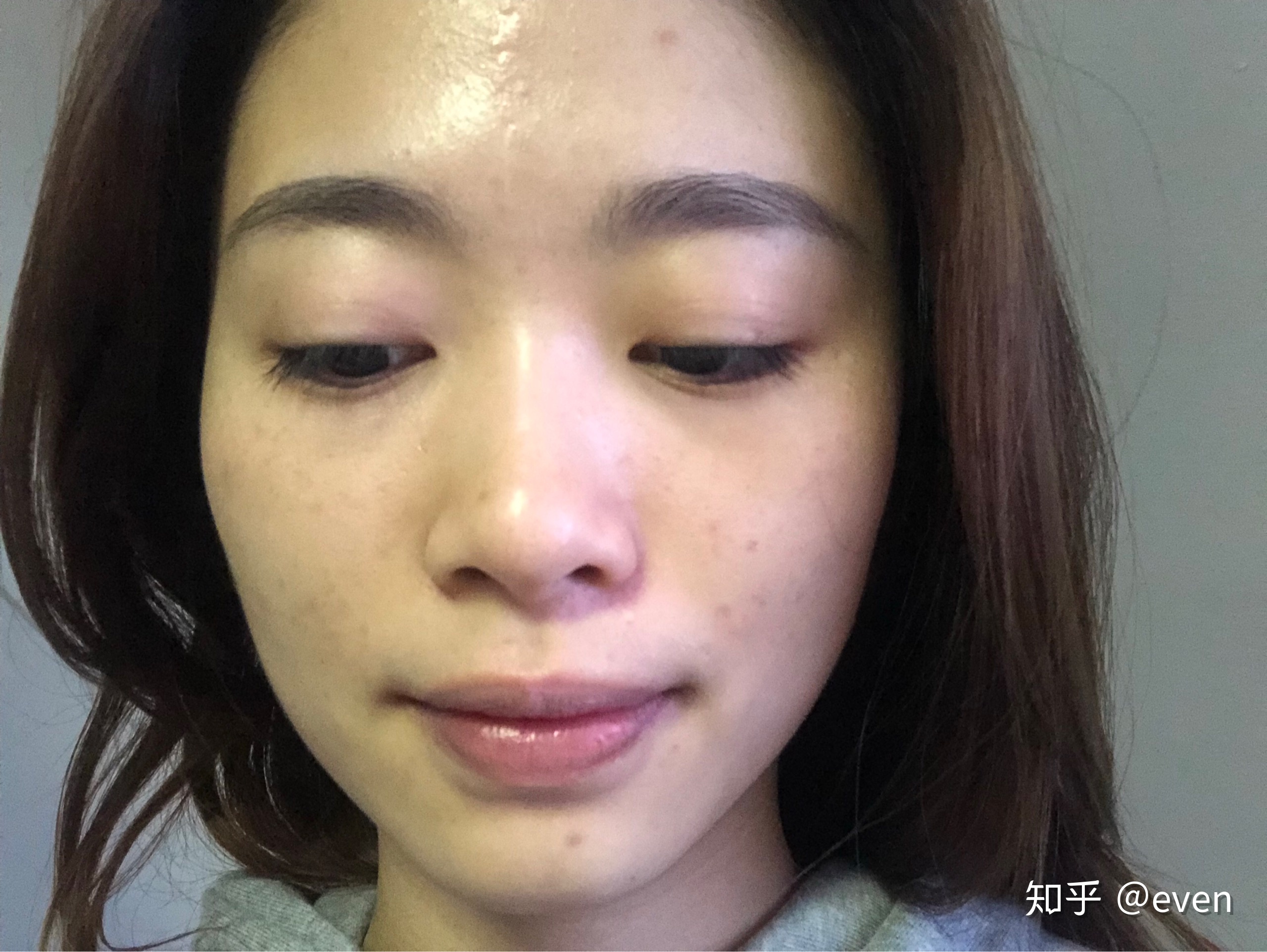 上海九院激光祛斑价格