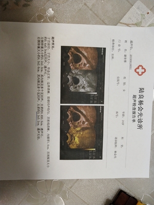 排卵期囊肿