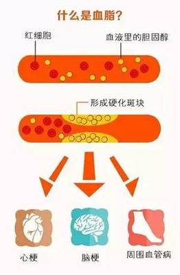 怎么能知道胆固醇高