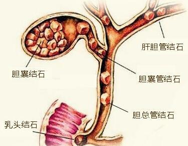 胆结石该怎么治疗