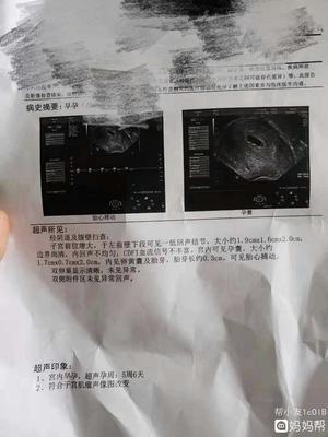 多囊怀孕