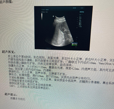 胆囊多发结石该怎么治疗