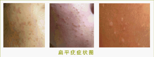 隆起的大痘痘