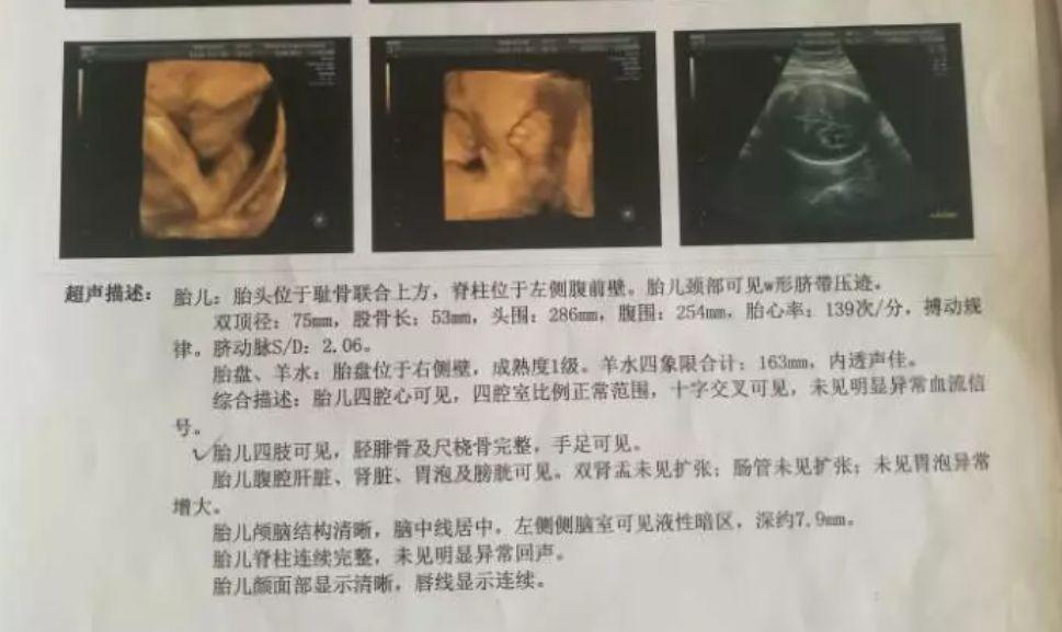 胎儿死亡赔偿标准
