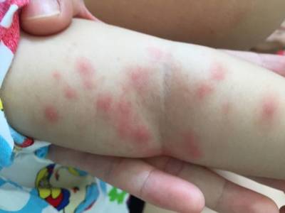 8个月宝宝身上长了很多红点
