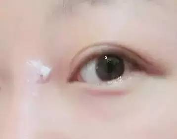 狮王化妆水痘痘变大了