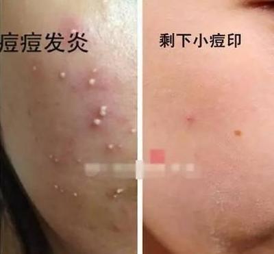 怎么根治痘痘的方法