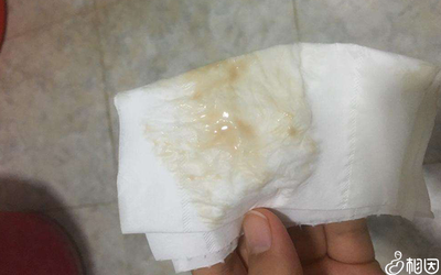 孕妇白带异常