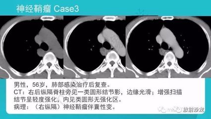 肺结节影是什么意思啊怎么治疗