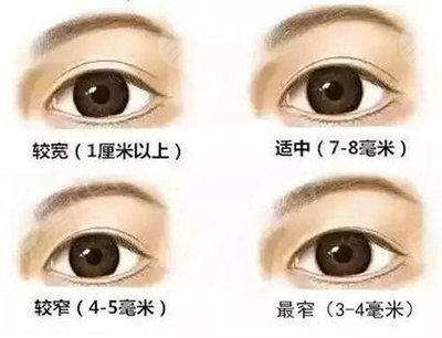 双眼皮如何修复