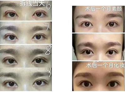 想做双眼皮