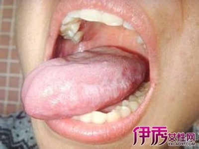 舌苔灰色是怎么回事